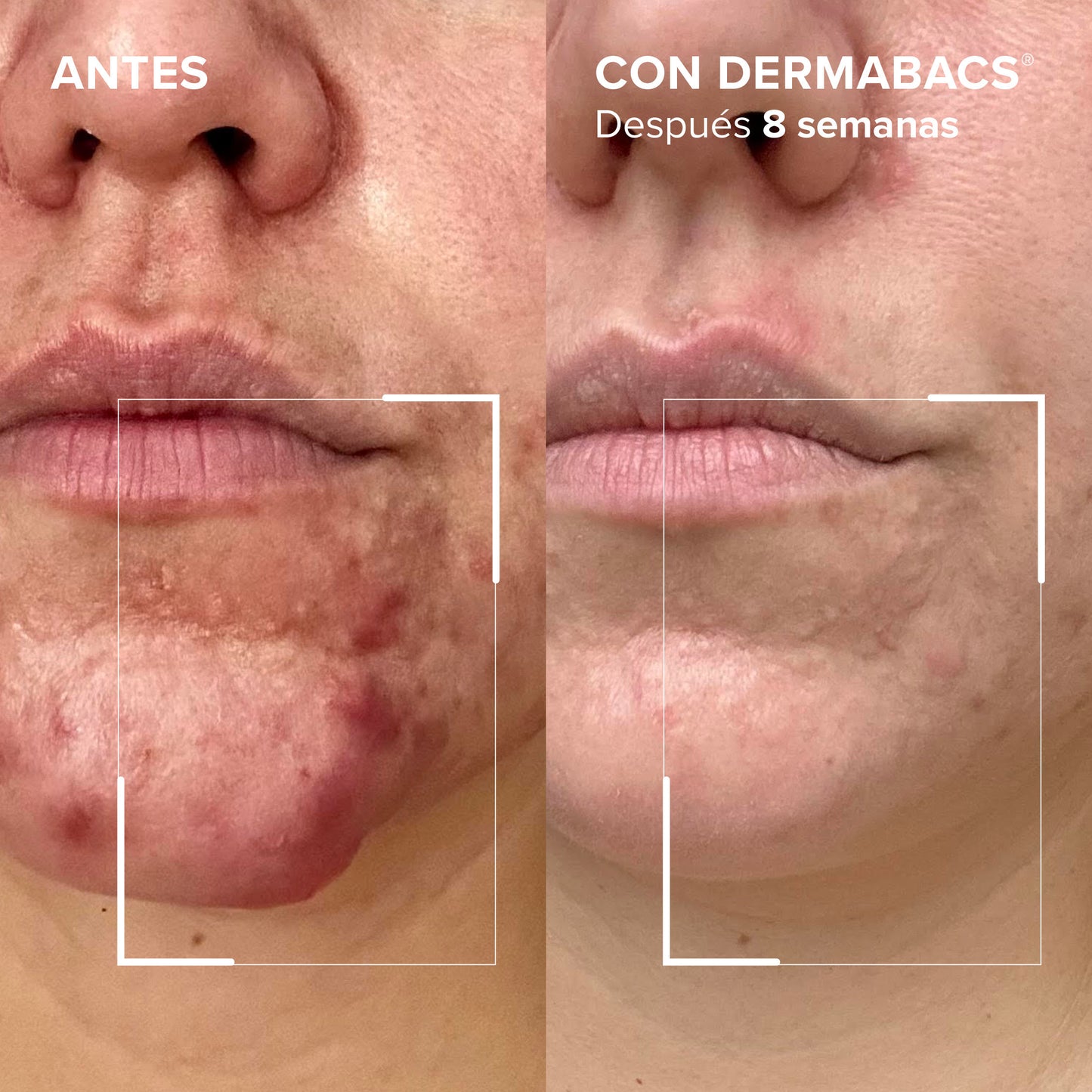 Dermabacs